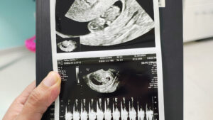 foto de una ecografía de embarazo para la columna por el Día del Padre